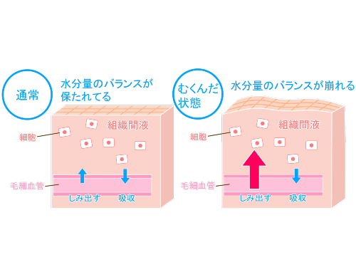 浮腫（むくみ）はなぜ起こる？その原因と解消方法 | 訪問看護ブログ | 株式会社 メディケア・リハビリ